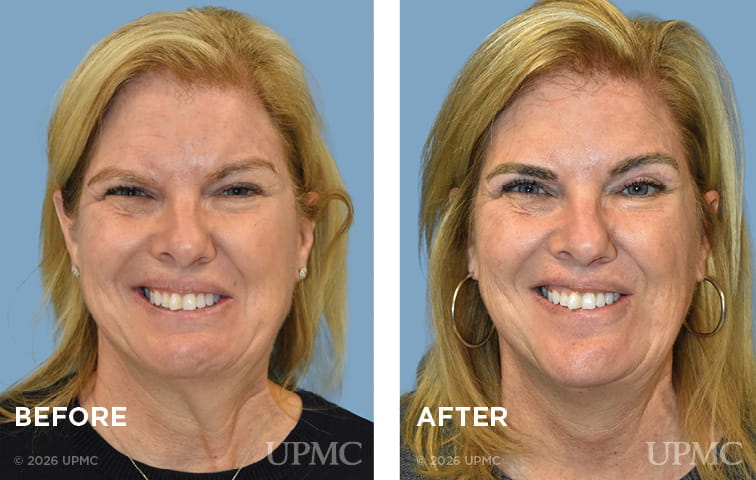 Patient with synkinesis before and after left DAO resection and upper blepharoplasty.
